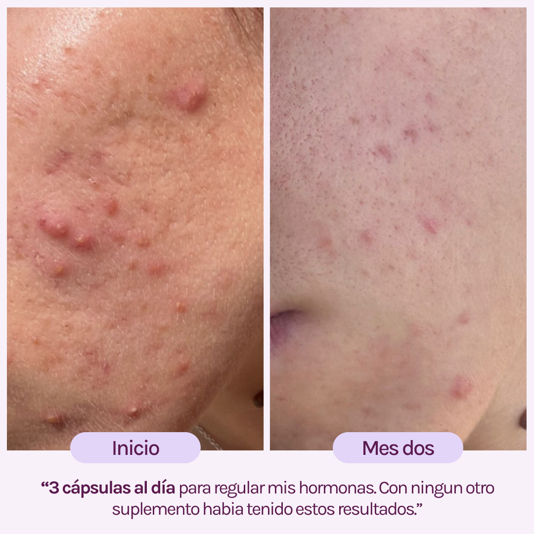 A CONTROL - ACNÉ HORMONAL & RESISTENCIA A LA INSULINA