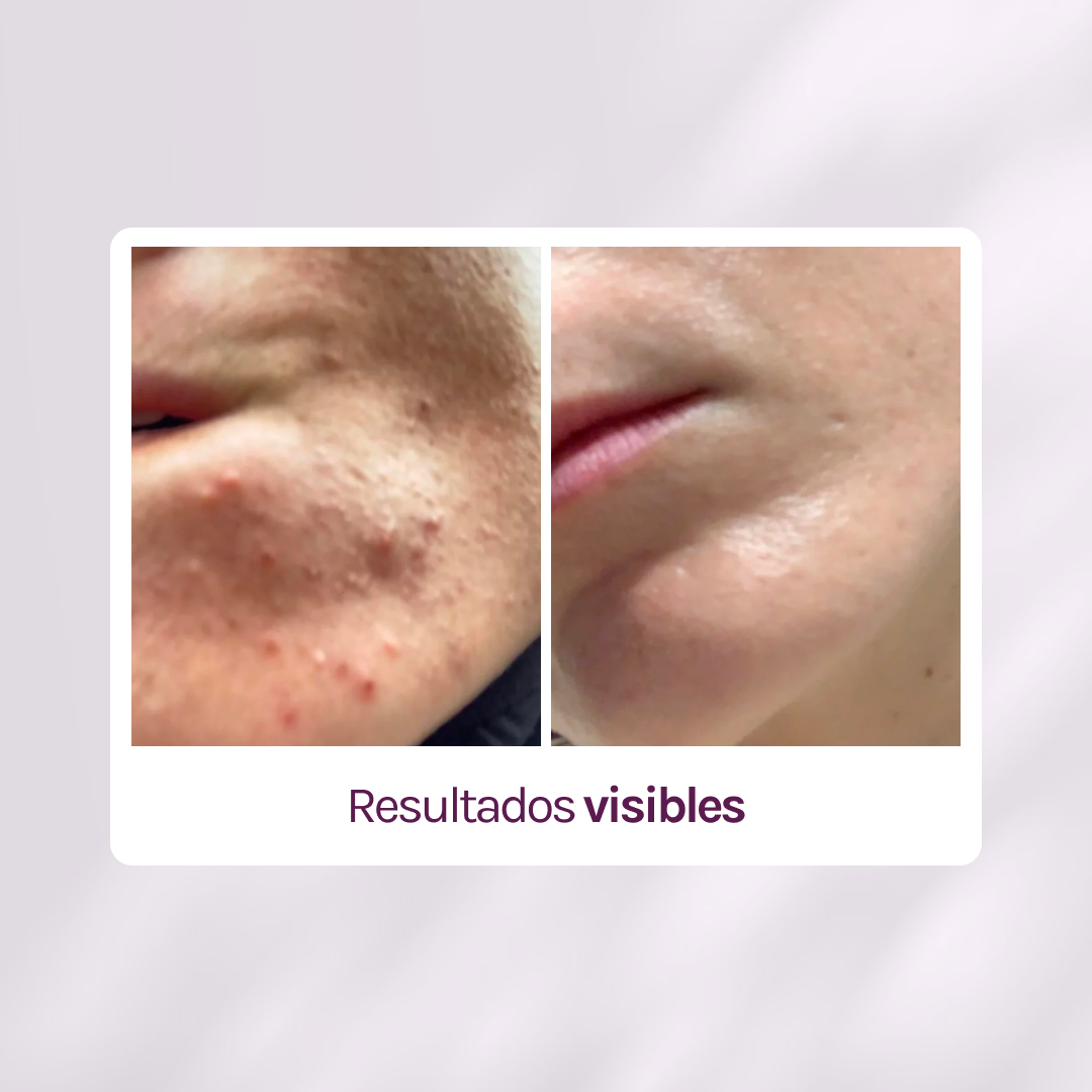 RUTINA FULL ACNÉ - ANTIBACTERIANA + GRANITOS + MARCAS + POROS