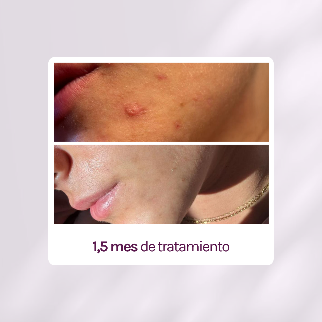 RUTINA FULL ACNÉ - ANTIBACTERIANA + GRANITOS + MARCAS + POROS