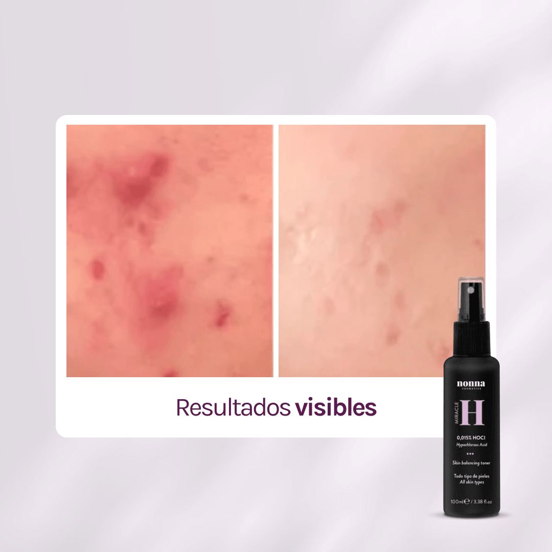 MIRACLE H - ÁCIDO HIPOCLOROSO - TÓNICO ANTIBACTERIANO Y ANTIINFLAMATORIO