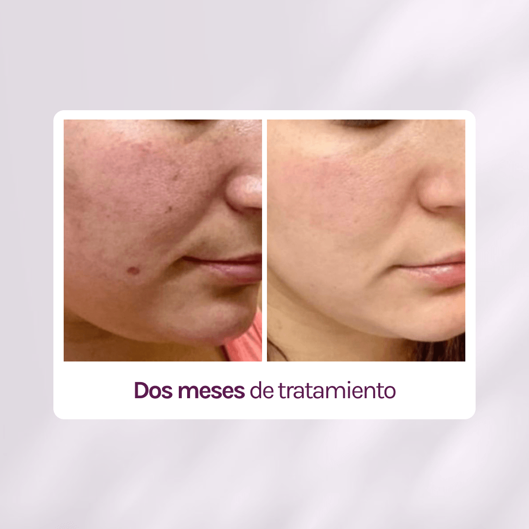 KIT TRATAMIENTO - MANCHAS + GRANITOS + IMPERFECCIONES