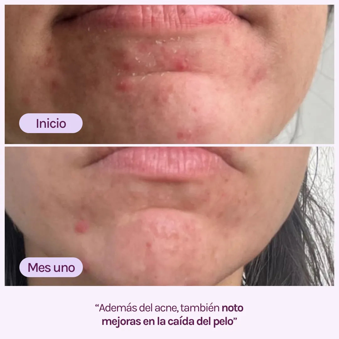 A CONTROL - ACNÉ HORMONAL & RESISTENCIA A LA INSULINA