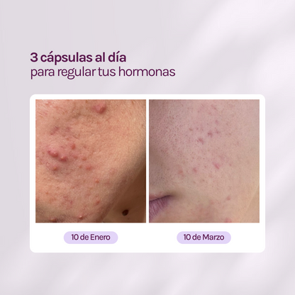 A CONTROL - ACNÉ HORMONAL &amp; RESISTENCIA A LA INSULINA