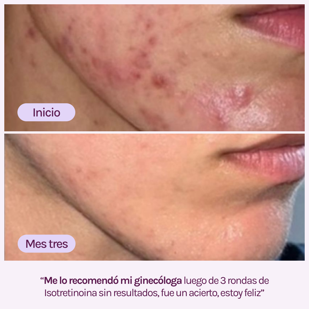 A CONTROL - ACNÉ HORMONAL &amp; RESISTENCIA A LA INSULINA