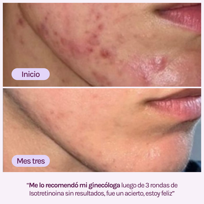 A CONTROL - ACNÉ HORMONAL &amp; RESISTENCIA A LA INSULINA