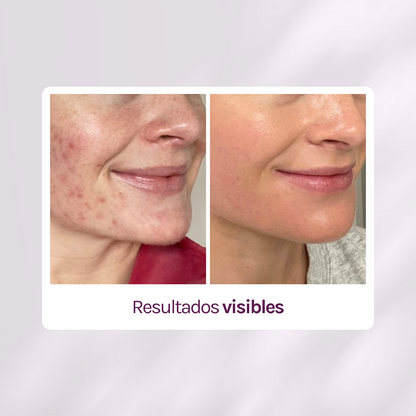 RUTINA AM&amp;PM - GRANITOS + MARCAS + POROS + MANCHAS + ARRUGAS