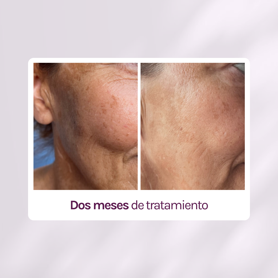 RUTINA AM&amp;PM - GRANITOS + MARCAS + POROS + MANCHAS + ARRUGAS