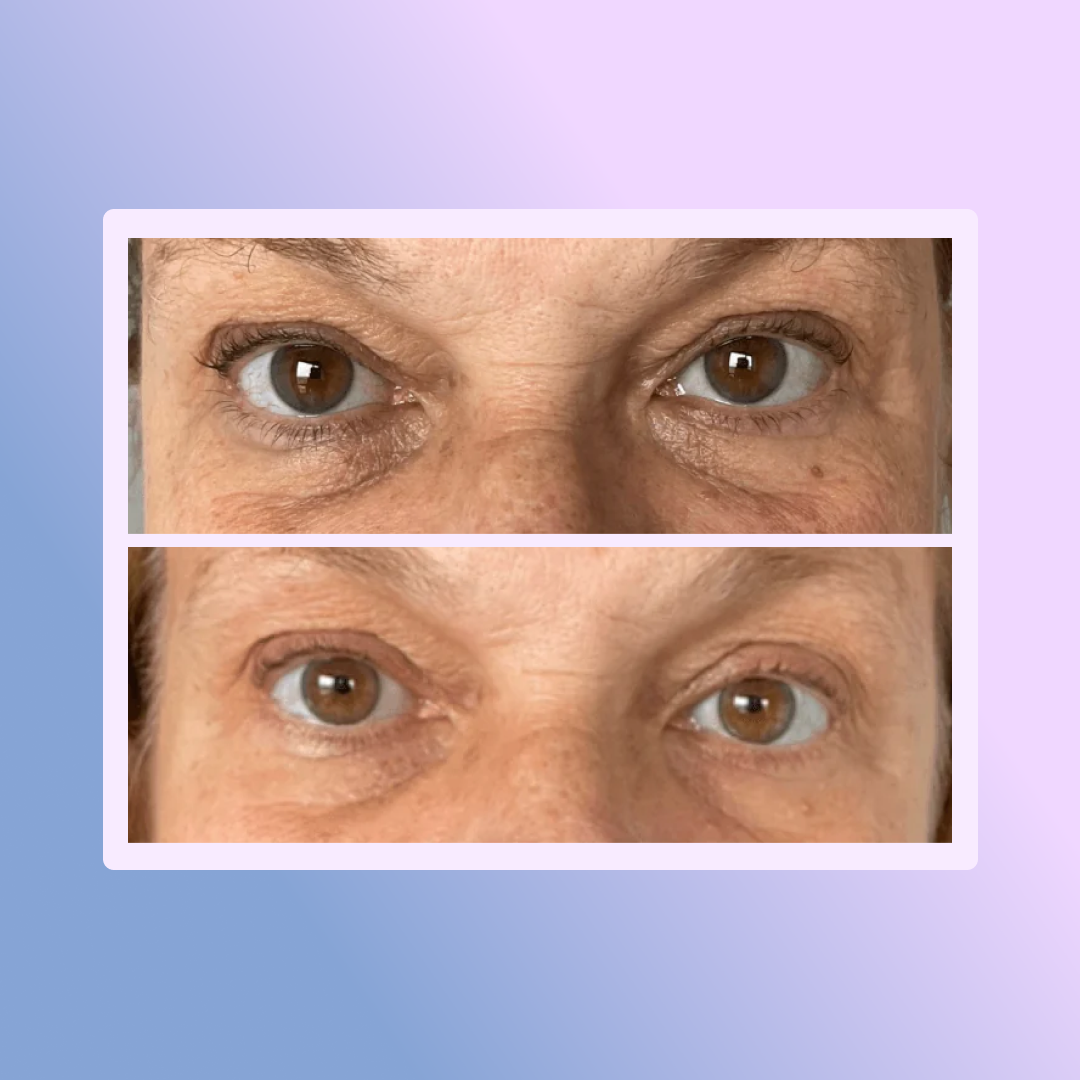 E COMPLEX Contorno de ojos - bolsas + ojeras