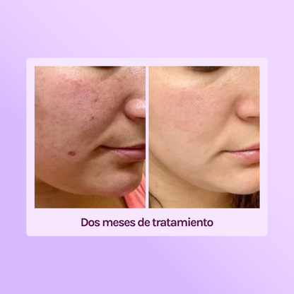 RUTINA FULL ACNÉ - ANTIBACTERIANA + GRANITOS + MARCAS + POROS