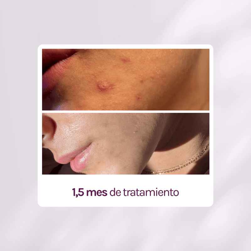 RUTINA FULL ACNÉ - ANTIBACTERIANA + GRANITOS + MARCAS + POROS
