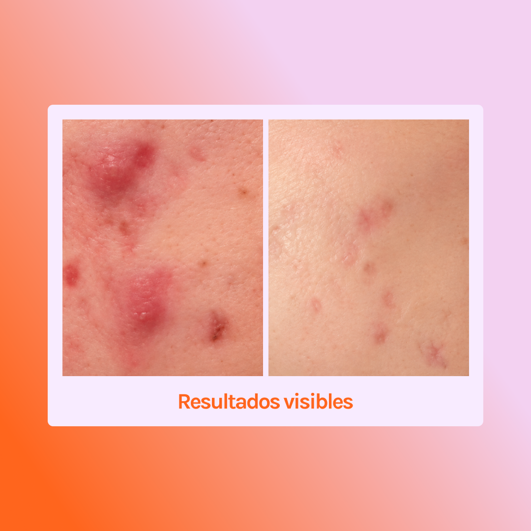 MIRACLE H -  ÁCIDO HIPOCLOROSO - TÓNICO ANTIBACTERIANO Y ANTIINFLAMATORIO