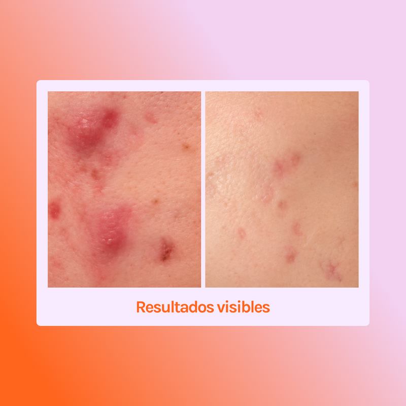 MIRACLE H -  ÁCIDO HIPOCLOROSO - TÓNICO ANTIBACTERIANO Y ANTIINFLAMATORIO