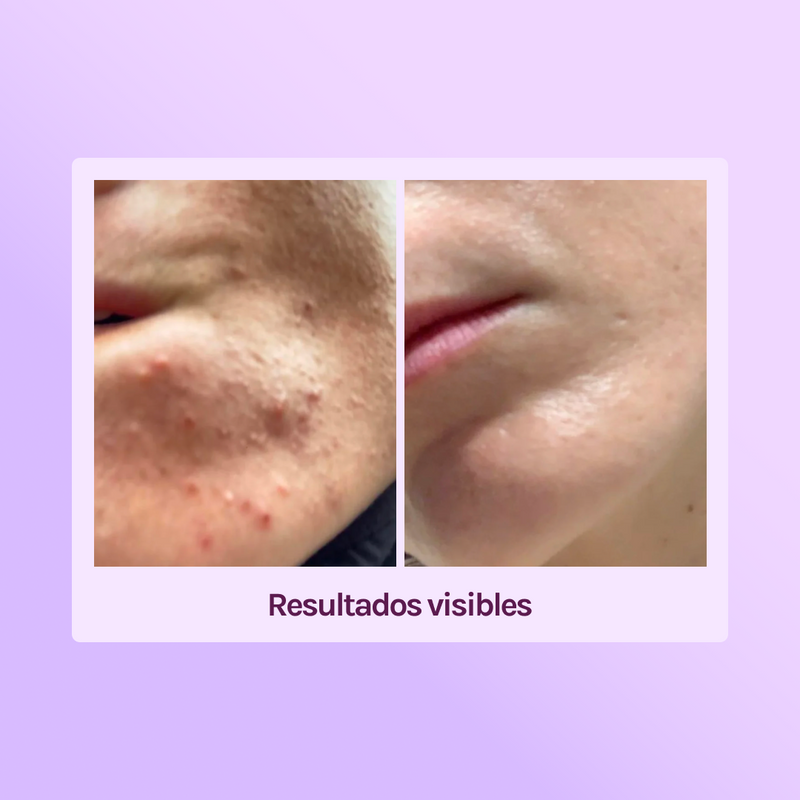 KIT TRATAMIENTO - MANCHAS + GRANITOS + IMPERFECCIONES