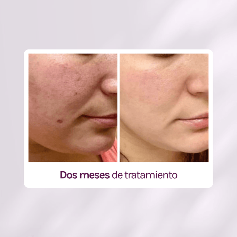 KIT TRATAMIENTO - MANCHAS + GRANITOS + IMPERFECCIONES